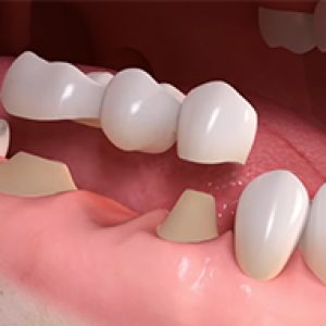 dental-bridges-treatment (2)