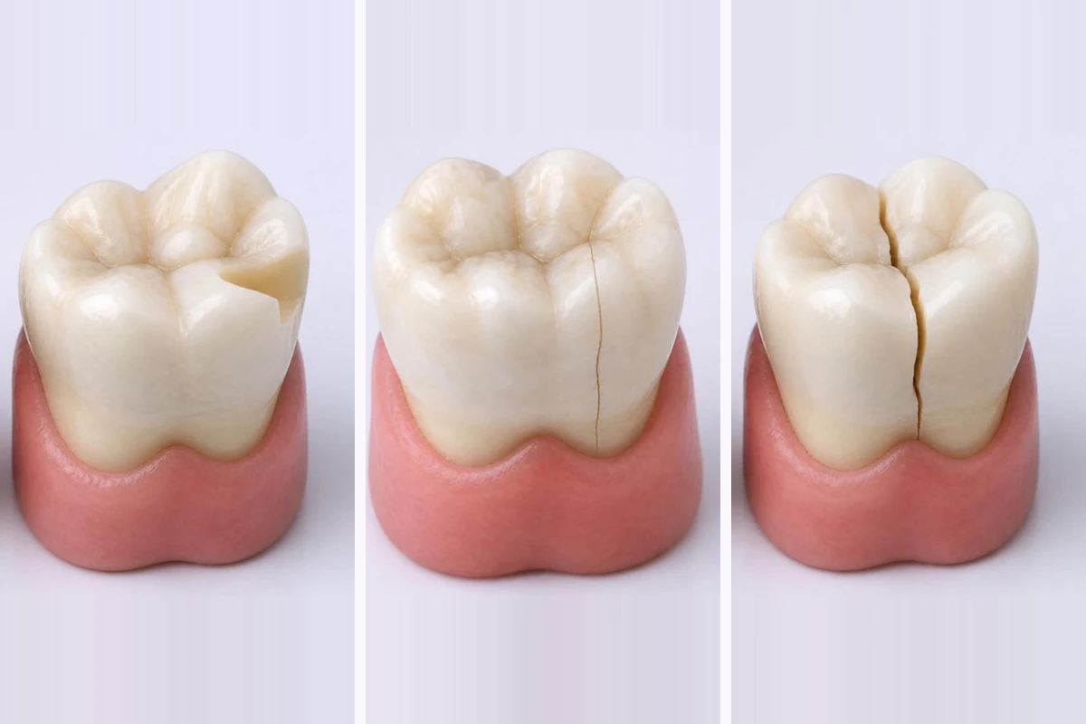 3D illustration of three back teeth side by side: the left with a corner of the chewing surface broken off, the middle with a thin crack running over the chewing surface and down the side of the crown, and the right with a deep crack splitting the crown into two parts