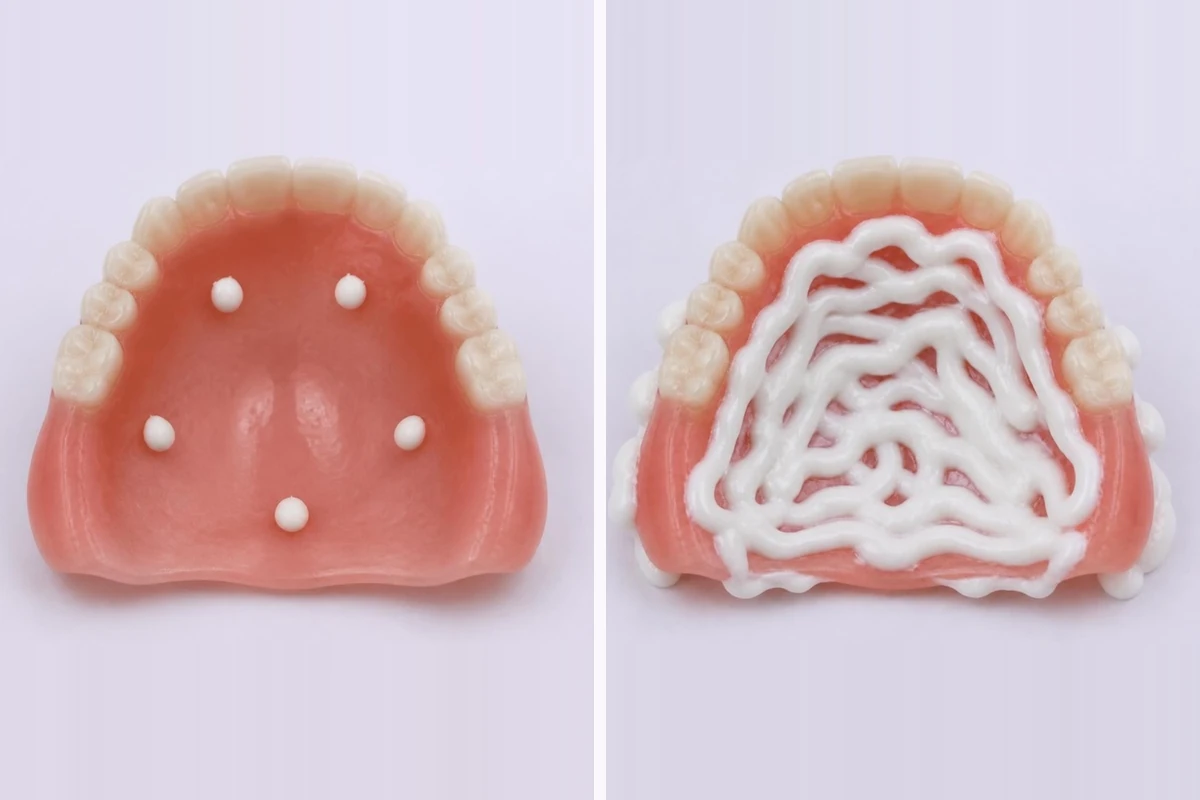 3D illustration of the fitting side of an upper denture twice: a few small dots of adhesive cream away from the edges, and far too much adhesive spread all over and squeezing past the edges