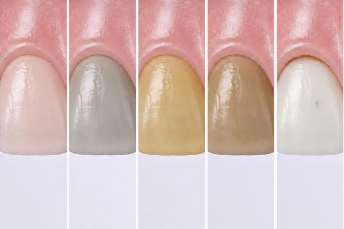 3D illustration of the same upper front tooth five times in different shades: pinkish, grey, dark yellow, brown, and a natural-colored tooth with a thin stain line at the gum and a small dark spot