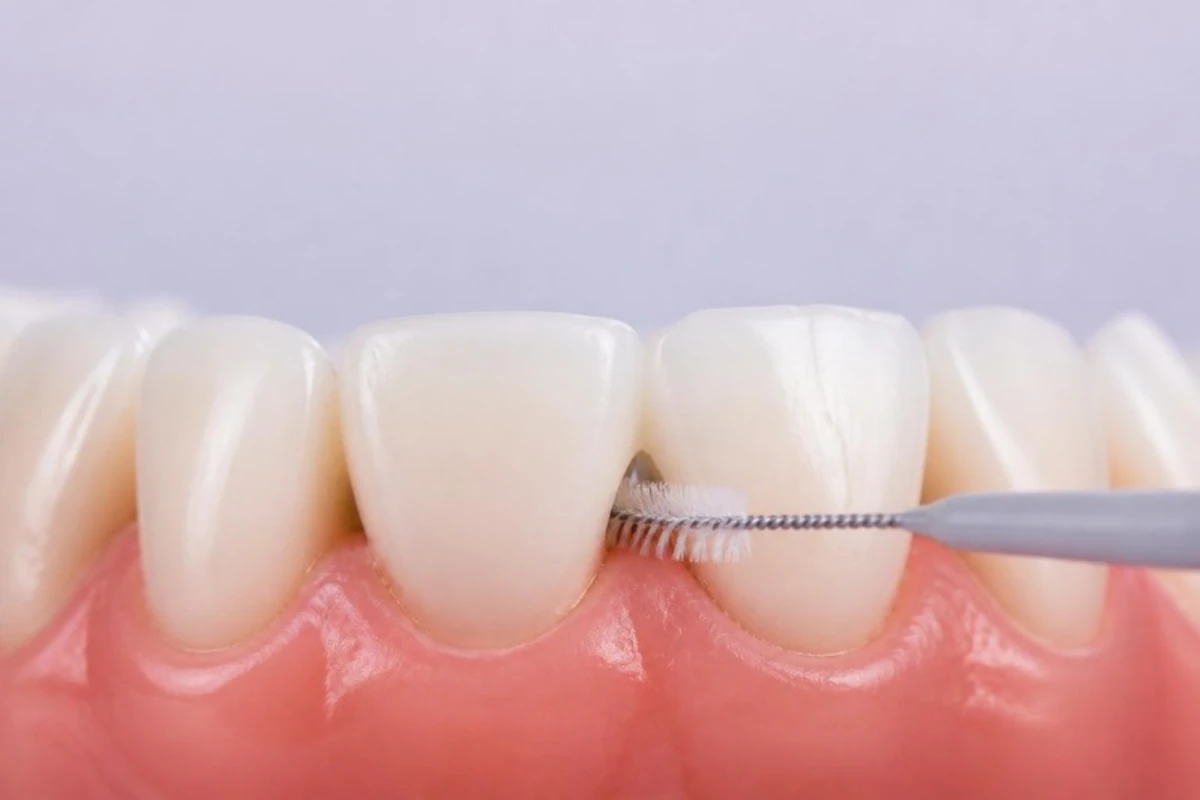 3D illustration of a small interdental brush passing through the gap between two lower front teeth at the gum line