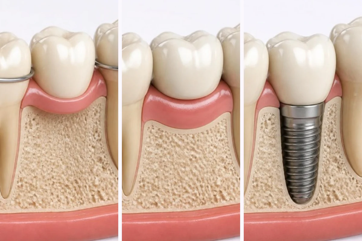 3D illustration of three ways to replace one missing back tooth, shown in a cutaway of gum and bone: a partial denture tooth held by clasps, a bridge joined to the neighbouring teeth, and a dental implant with a crown