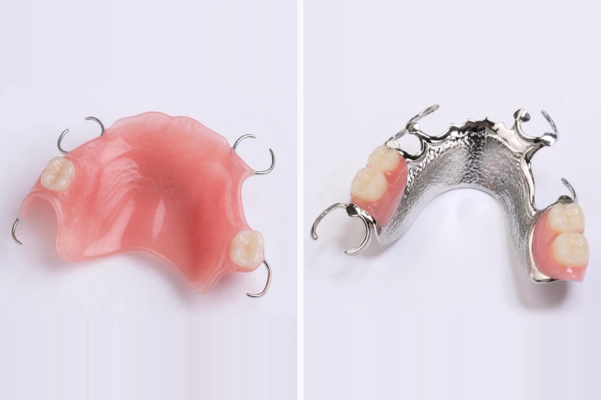3D illustration of two upper partial dentures: a temporary pink acrylic denture covering much of the palate with wire clasps, and a metal-framework denture with a thin metal plate across the palate and cast clasps
