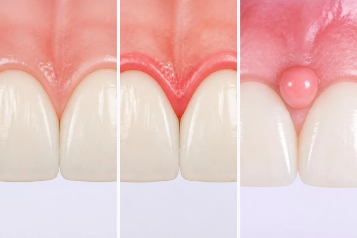 3D illustration of the upper front teeth and gums three times: healthy pink gums fitting snugly around the teeth, puffy red gum edges, and a small soft red lump on the gum between the two front teeth