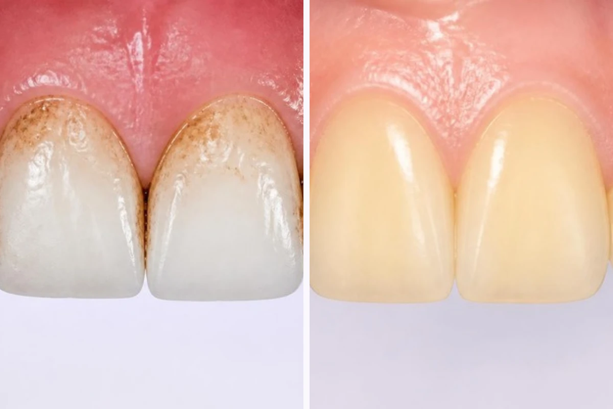 3D illustration in two parts: front teeth with brown stains on the enamel surface near the gums, and evenly yellowish front teeth whose color comes from inside the tooth