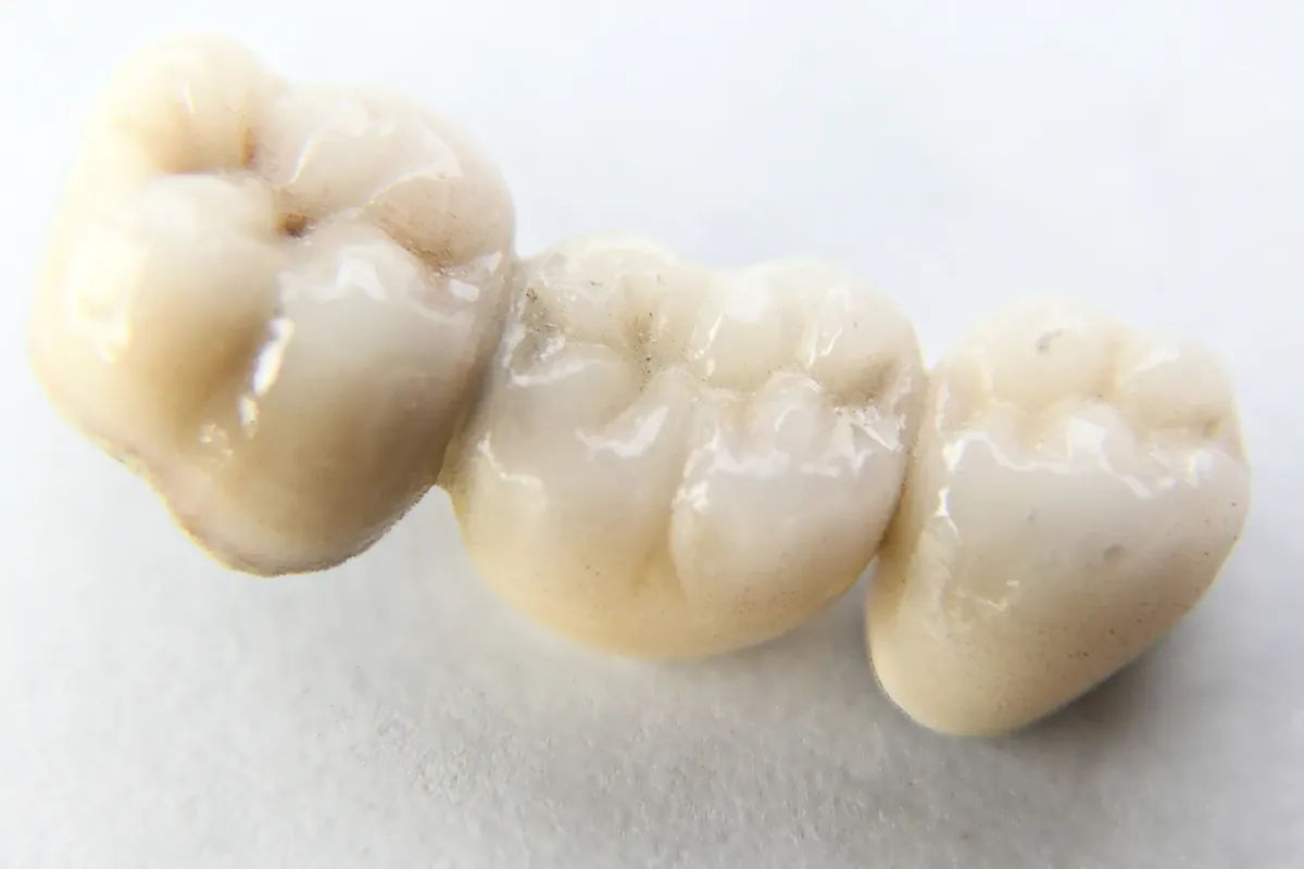 A three-unit porcelain-fused-to-metal dental bridge on a white surface