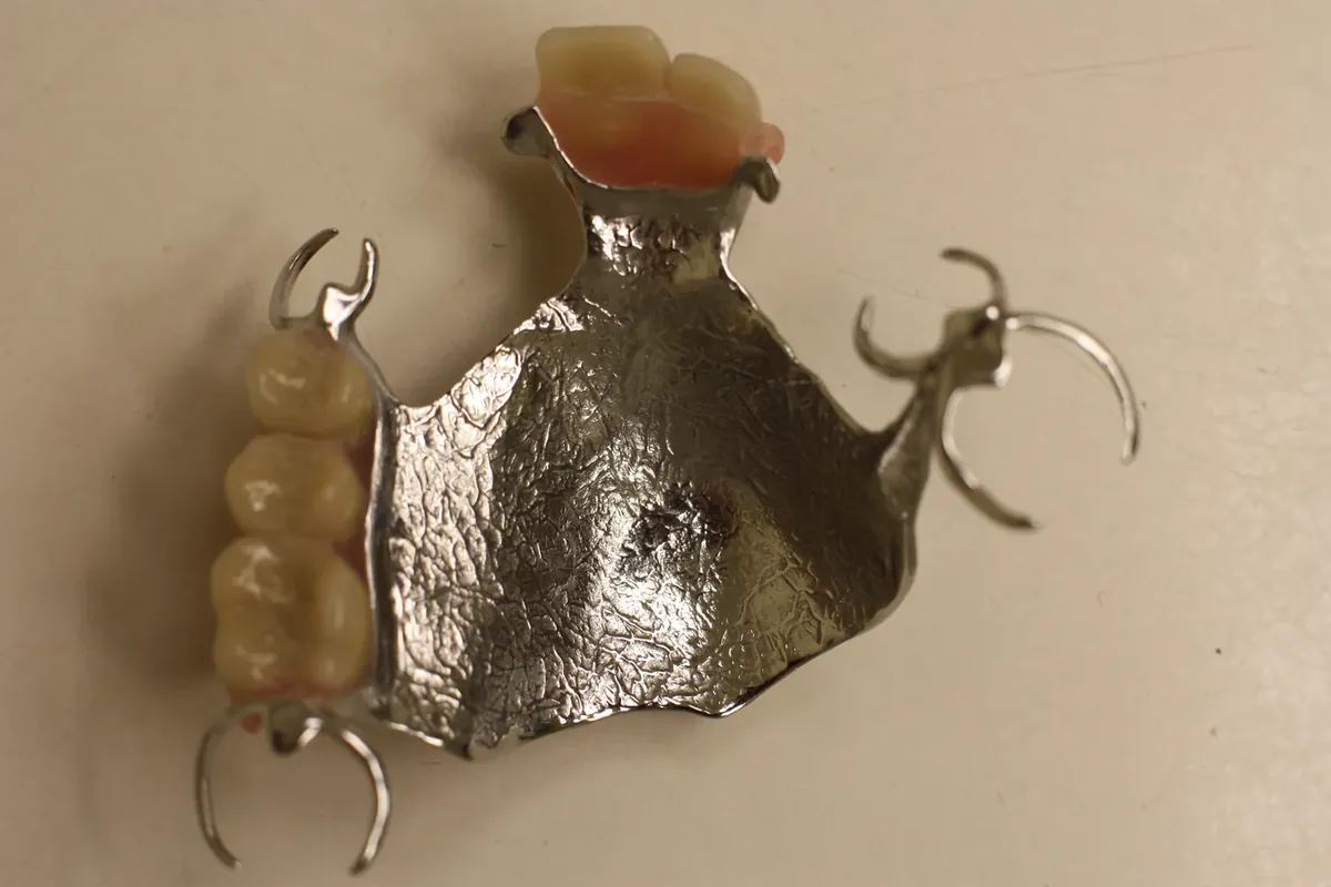 An upper partial denture with a cast metal framework, metal clasps and replacement teeth
