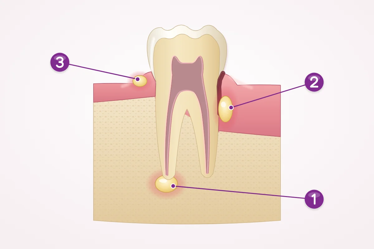 Illustration of a back tooth in cross-section showing where an abscess can form: at the root tip, beside the root in a deep gum pocket, and in the gum edge