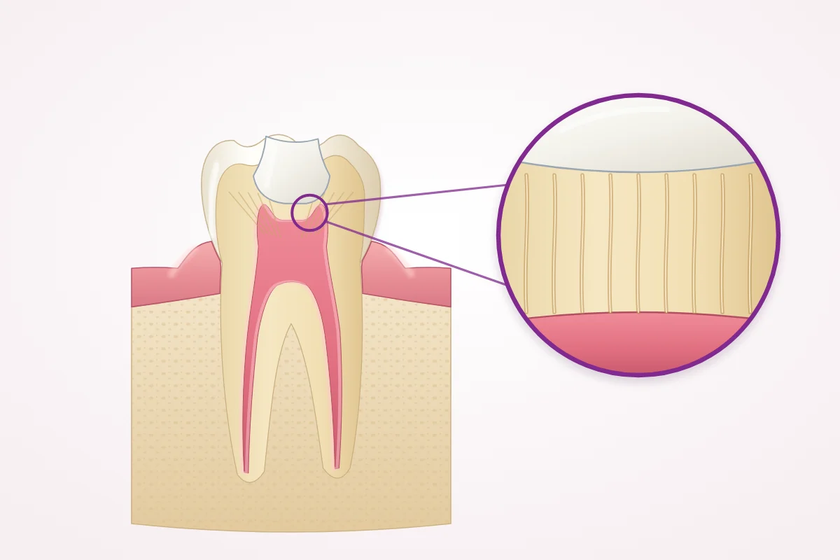 Illustration of a back tooth in cross-section with a deep tooth-colored filling close to the pulp, and a magnified view of the tiny tubules in the dentin