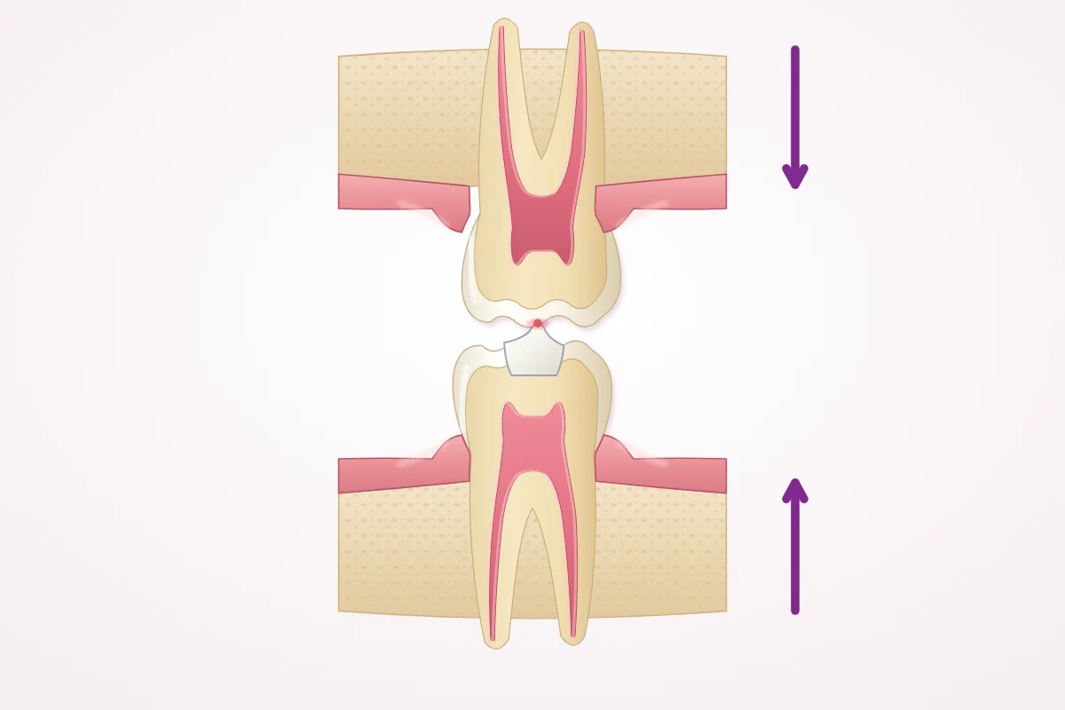 Illustration of an upper back tooth biting down on a lower back tooth with a new filling, touching first on a small high spot of the filling