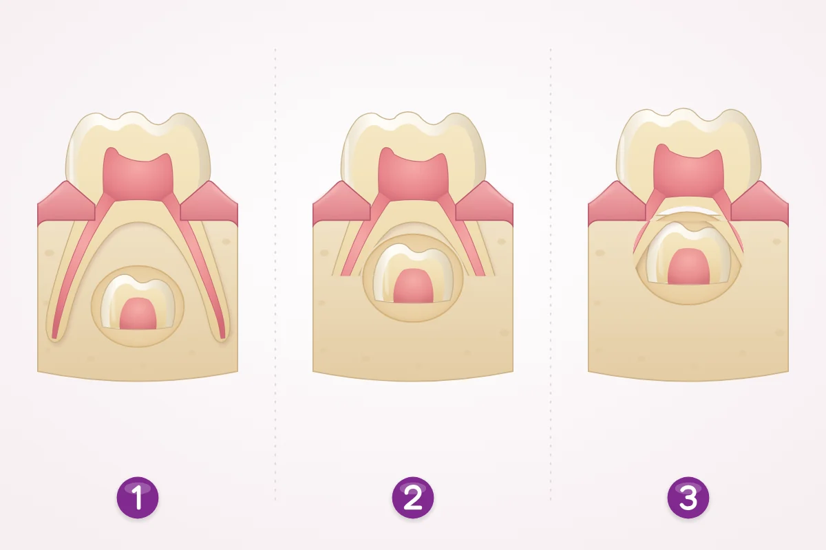 Illustration of a baby back tooth cut in half in three stages, with the adult tooth below it moving up as the baby roots shrink until the baby tooth is loose