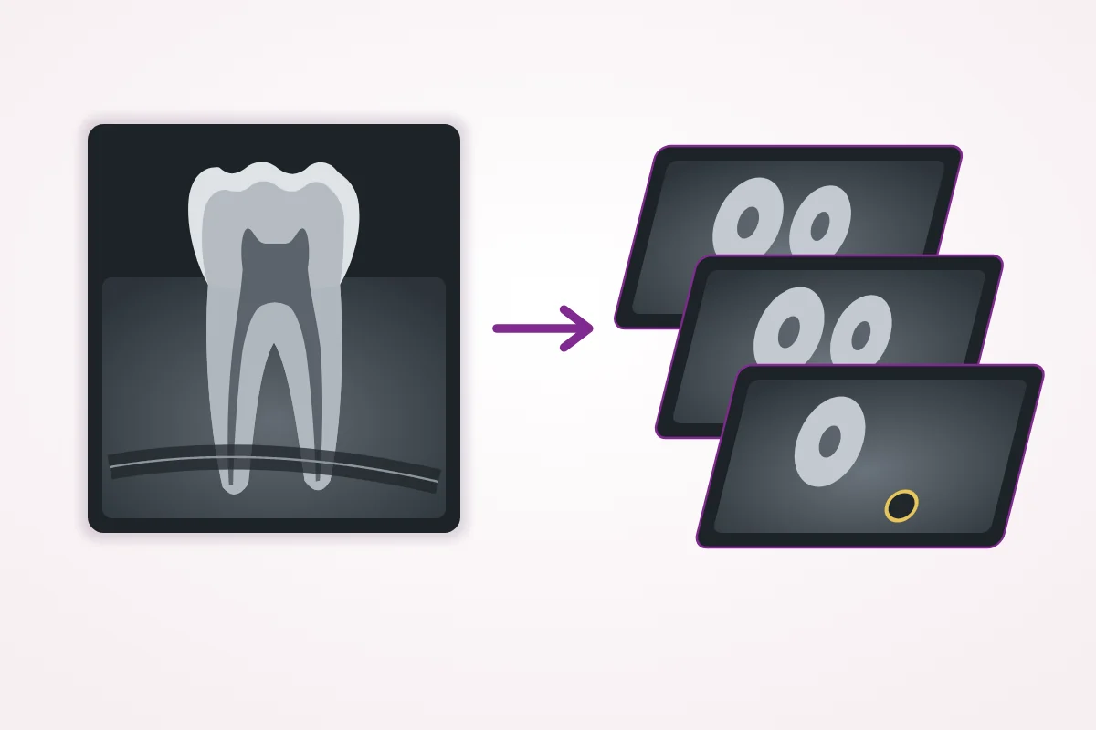 Illustration comparing a flat X-ray, where the tooth root and the nerve canal overlap, with 3D slices that show them separately