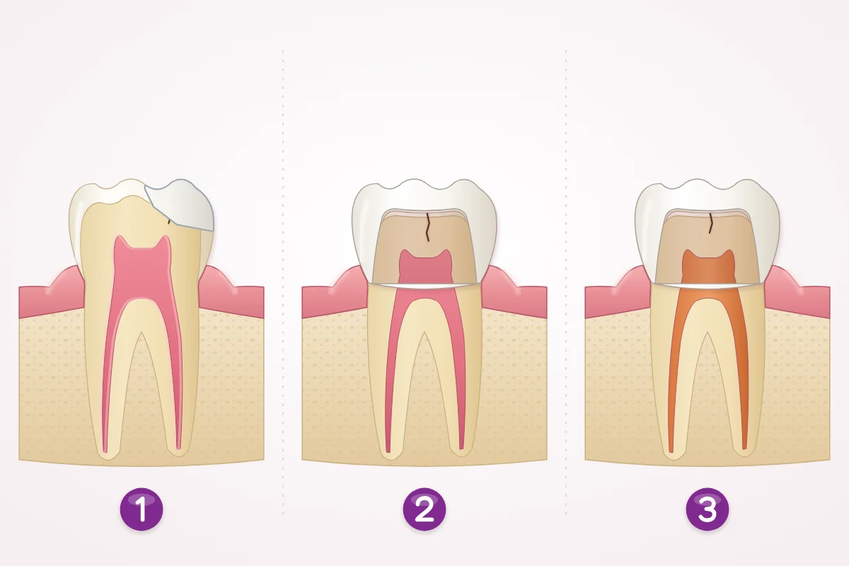 Illustration of three ways to protect a cracked back tooth: an onlay over the cracked cusp, a crown over the whole tooth, and a root canal filling with a crown on top