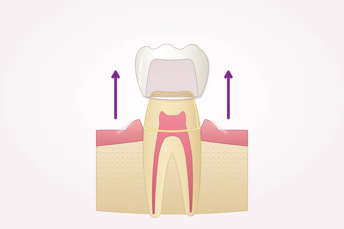 Illustration of a crown lifted off a prepared back tooth in cross-section, with a thin layer of dental cement still on the tooth
