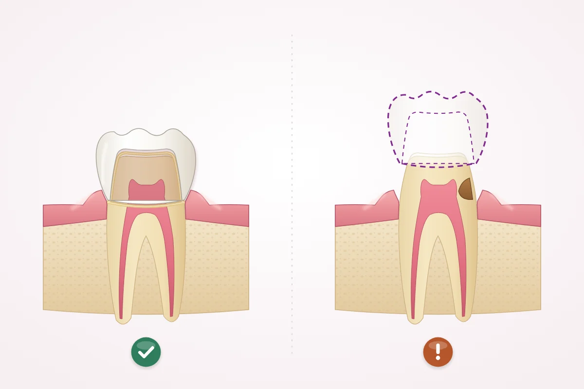 Illustration comparing a sound prepared tooth with its crown seated back on, and a prepared tooth with decay at the edge with the outline of a new crown planned above it