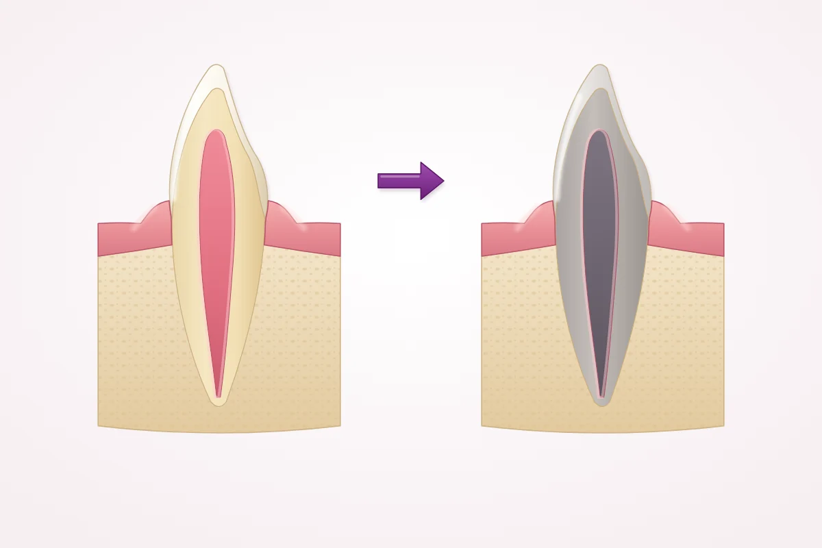 Illustration of a front tooth in cross-section: healthy with a pink pulp, and the same tooth after the pulp has died, with the pulp and tooth turned grey