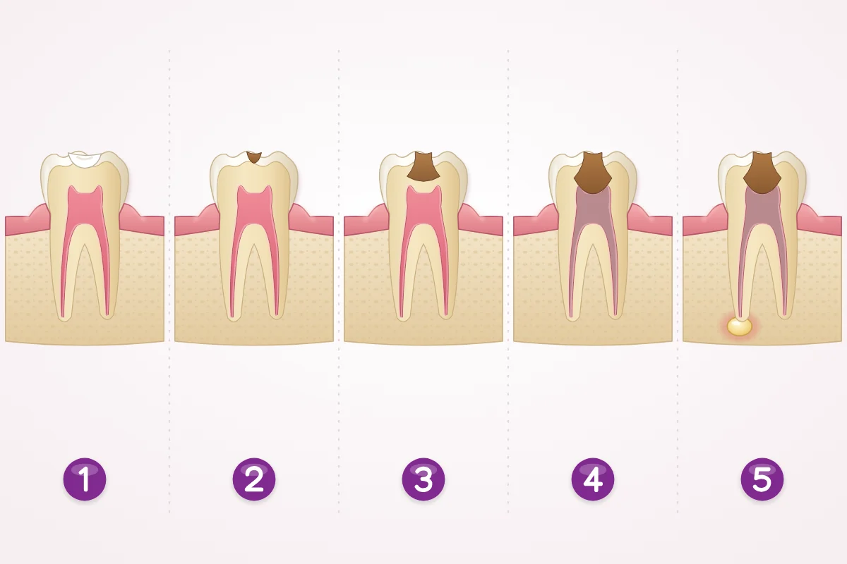 Illustration of five stages of decay in a back tooth: a white spot, a small hole in the enamel, decay in the dentin, decay reaching the pulp, and infection at the root tip