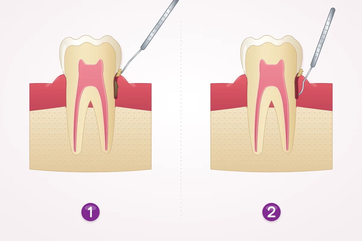 Illustration comparing a regular cleaning that works above the gum with deep cleaning that reaches the root inside the gum pocket