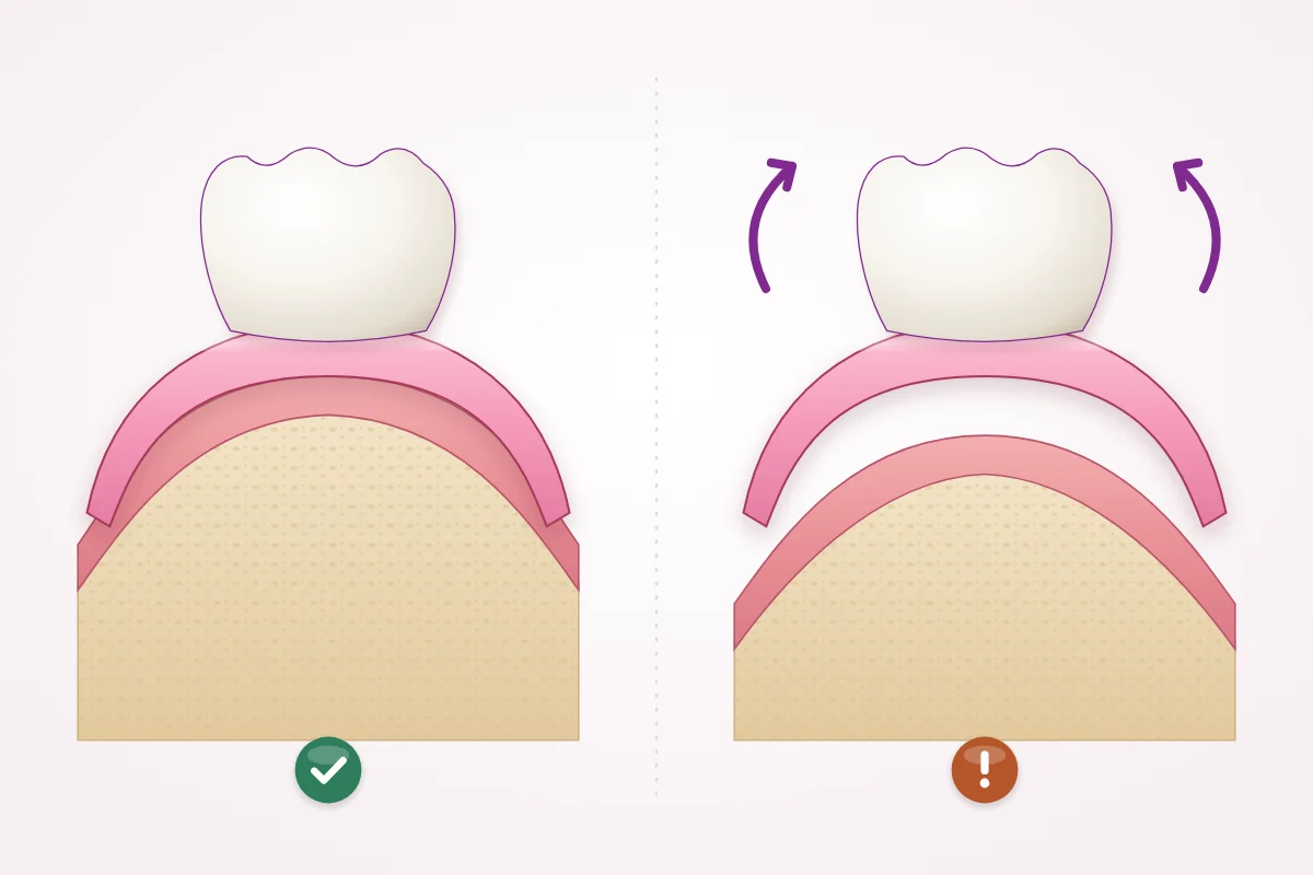 Illustration of a denture in cross-section resting closely on the jaw ridge, and the same denture with a gap after the ridge has shrunk, so it rocks