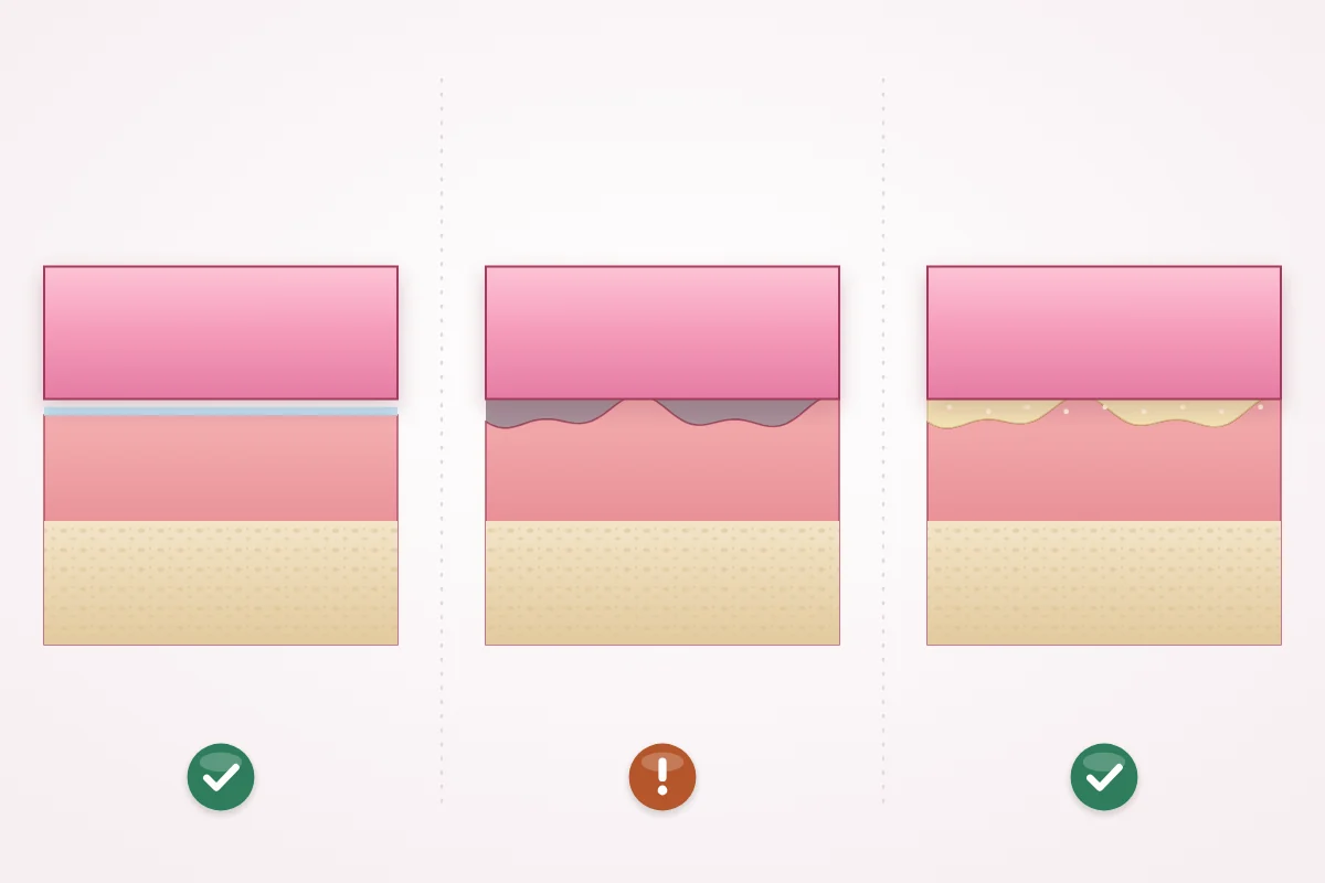 Illustration of a denture base on the gum: sealed by a thin film of saliva, small gaps after the gum changes, and the gaps filled by a layer of adhesive