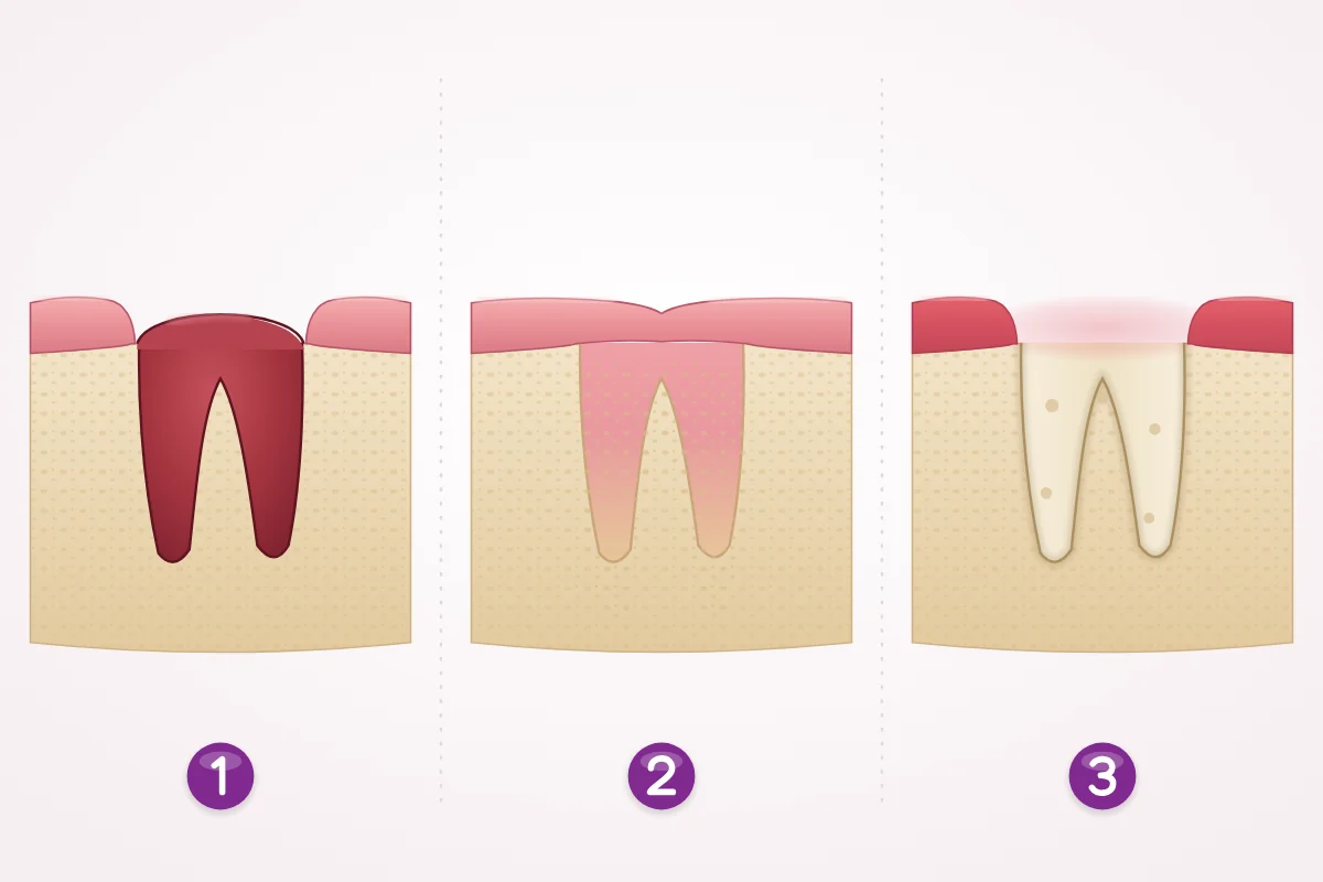 Three cross-sections of the same lower back tooth socket in the jawbone after an extraction: a dark red blood clot filling the socket; gum grown over the top of the socket while it heals; and an empty socket with bare, pale bone walls where the clot has been lost