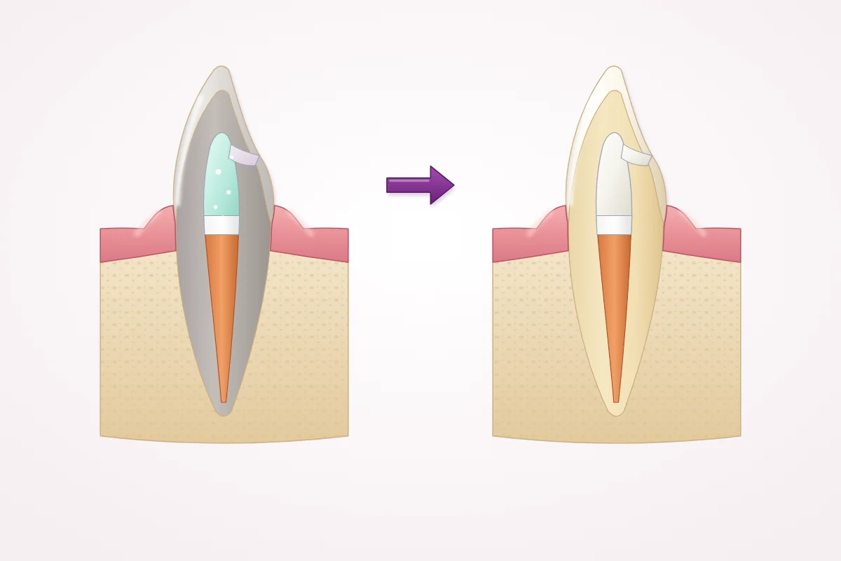 Illustration of whitening a root-treated front tooth from the inside: whitening gel in the crown above a white seal over the root filling, and the same tooth after it has become lighter