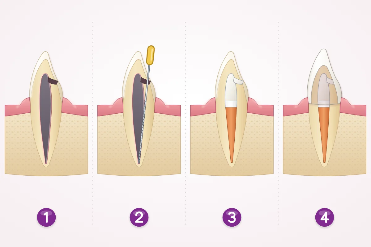 Illustration of root canal treatment of a front tooth in four steps: a small opening into the dead pulp, a fine file cleaning the canal, the canal filled and sealed, and a crown on top