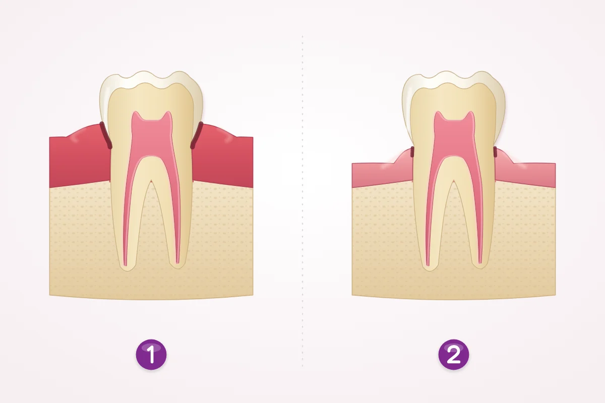 Illustration of swollen gums before treatment and firmer gums after healing, with the gum edge a little lower so the tooth looks longer