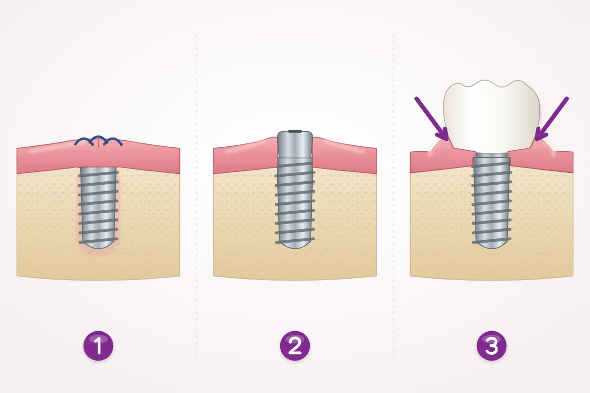 Three stages of one dental implant cut in half in its bone and gum: on the day of surgery the implant sits in the bone and the gum is stitched closed over it with blue stitches; while the bone heals a metal healing cap comes up through the gum; and after the crown is fitted, two purple arrows point to where the crown meets the gum