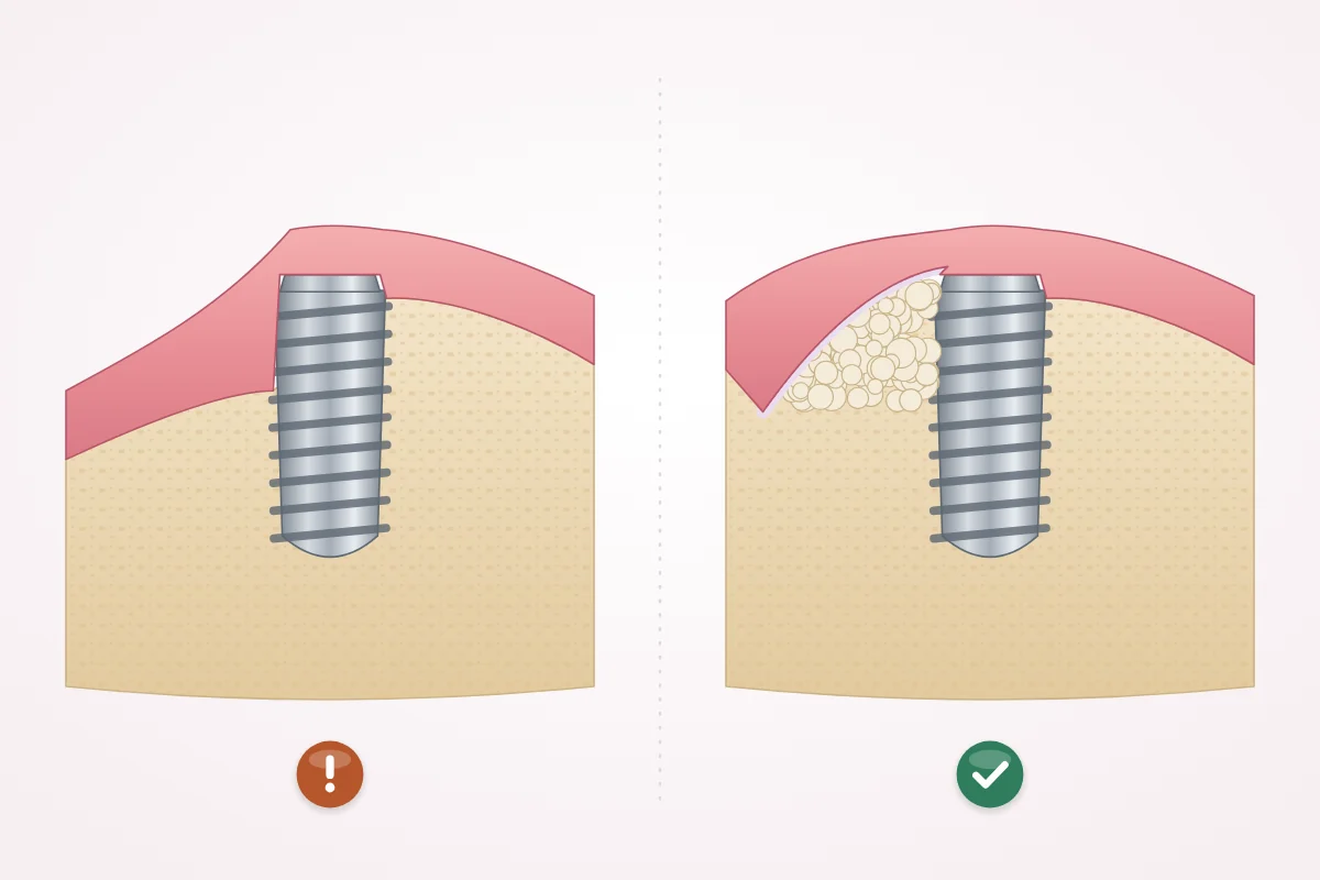 Illustration of bone grafting: thin bone around the top of an implant on the left, and added graft material around it on the right