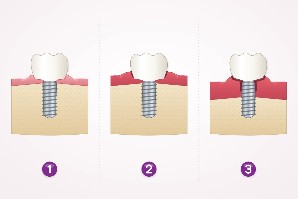 Illustration of the gum around an implant: healthy gum and bone, swollen gum with the bone level unchanged, and a deeper pocket with bone loss around the implant threads