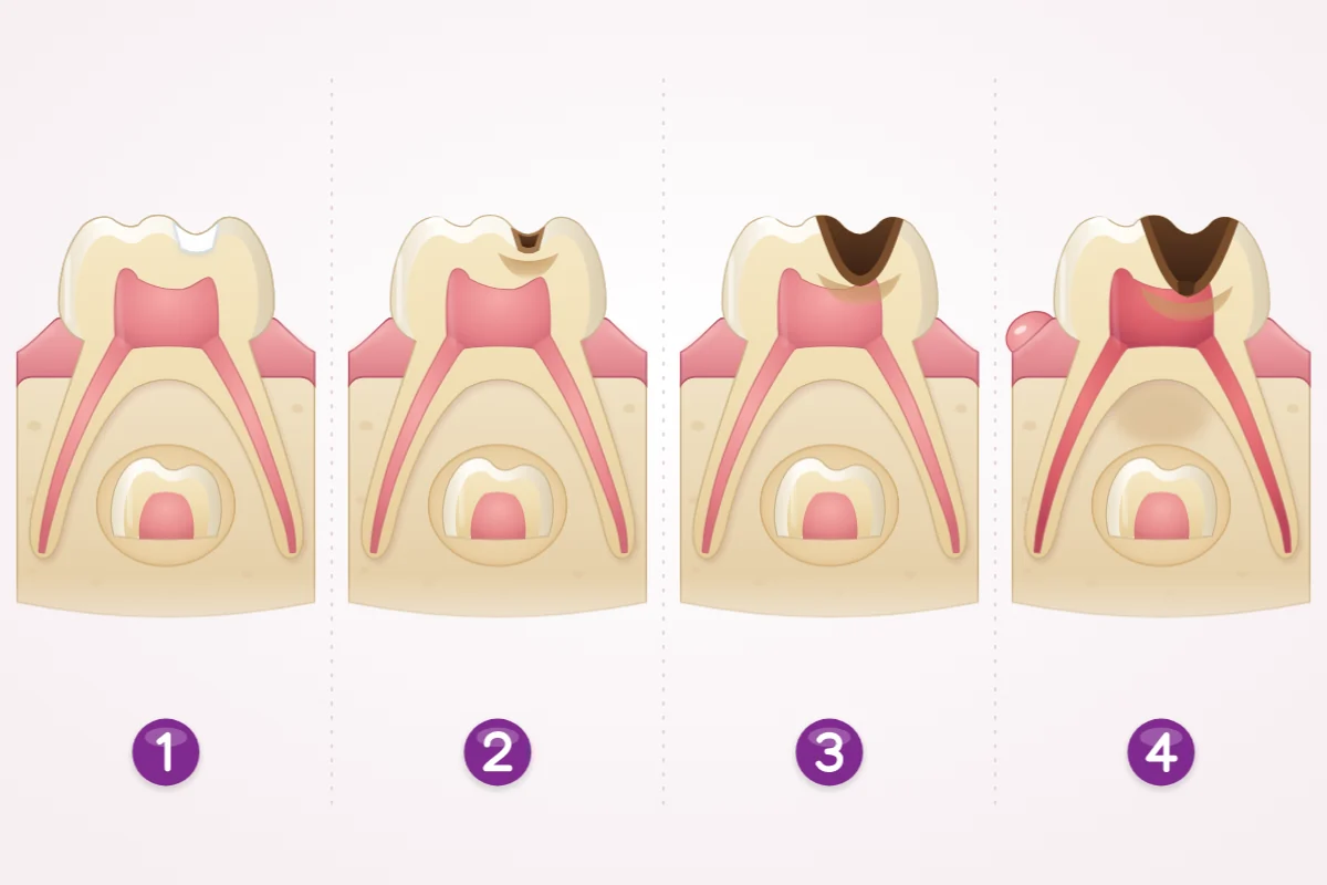 Illustration of a baby back tooth cut in half, in four stages: a chalky white spot in the enamel, a small brown cavity, a larger cavity deep in the tooth, and decay reaching the nerve with a small bump on the gum. A developing adult tooth sits between the roots.