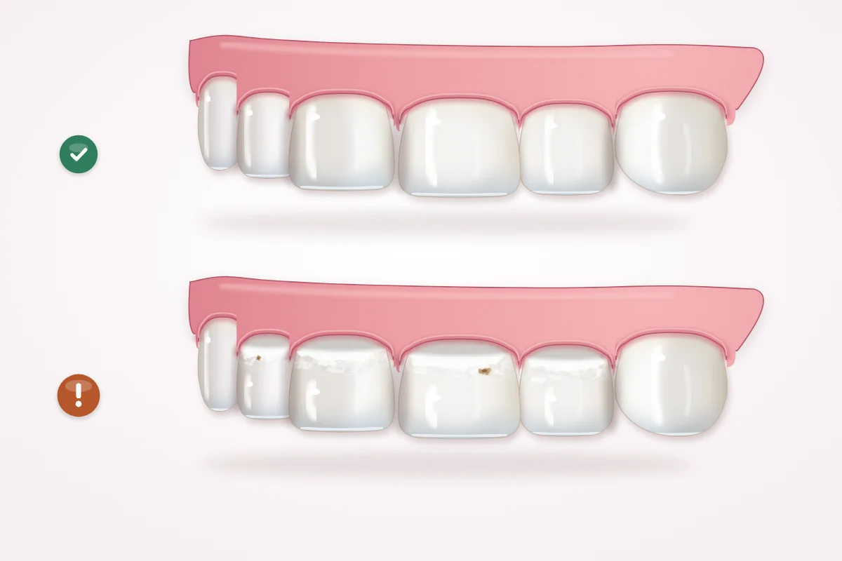 Illustration of upper baby front teeth seen at a slight angle: healthy teeth on top; below, chalky white, slightly sunken patches along the gum line with a few small brown spots
