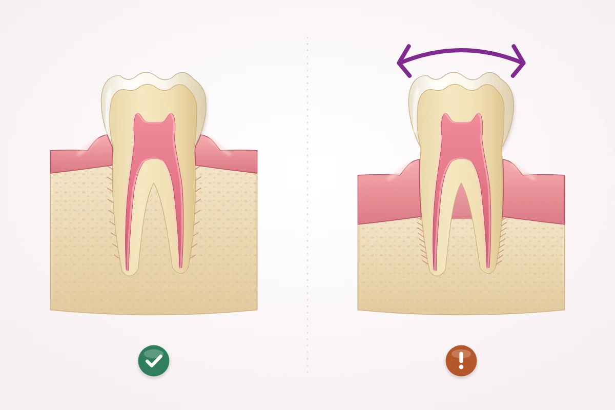 Illustration comparing a firm tooth held by bone and ligament fibres with a tooth that sways because the bone around its root has shrunk