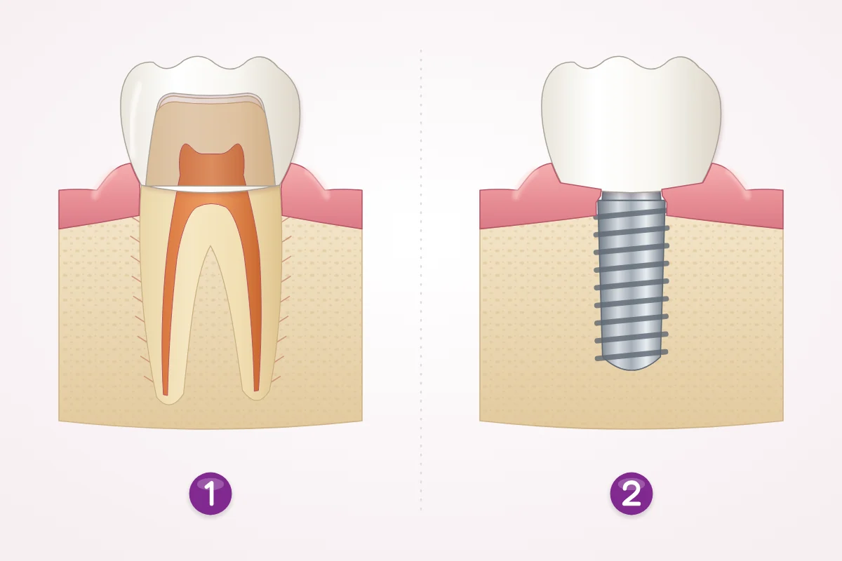 Two back teeth cut in half in their bone and gum: on the left, a natural tooth after root canal treatment, its canals filled with orange material and a crown on top, with fine ligament fibres between the root and the bone; on the right, a threaded metal implant in the bone with a crown on top and no ligament