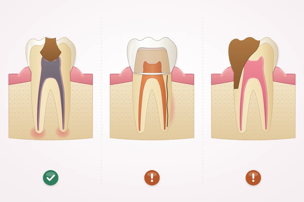 Three back teeth cut in half in their bone: a decayed tooth with a grey, infected nerve and red areas of inflammation at both root tips, marked with a tick; a root-filled tooth with a crown and a dark crack running down one root, marked with an exclamation sign; and a tooth with brown decay reaching down one side below the bone level, marked with an exclamation sign