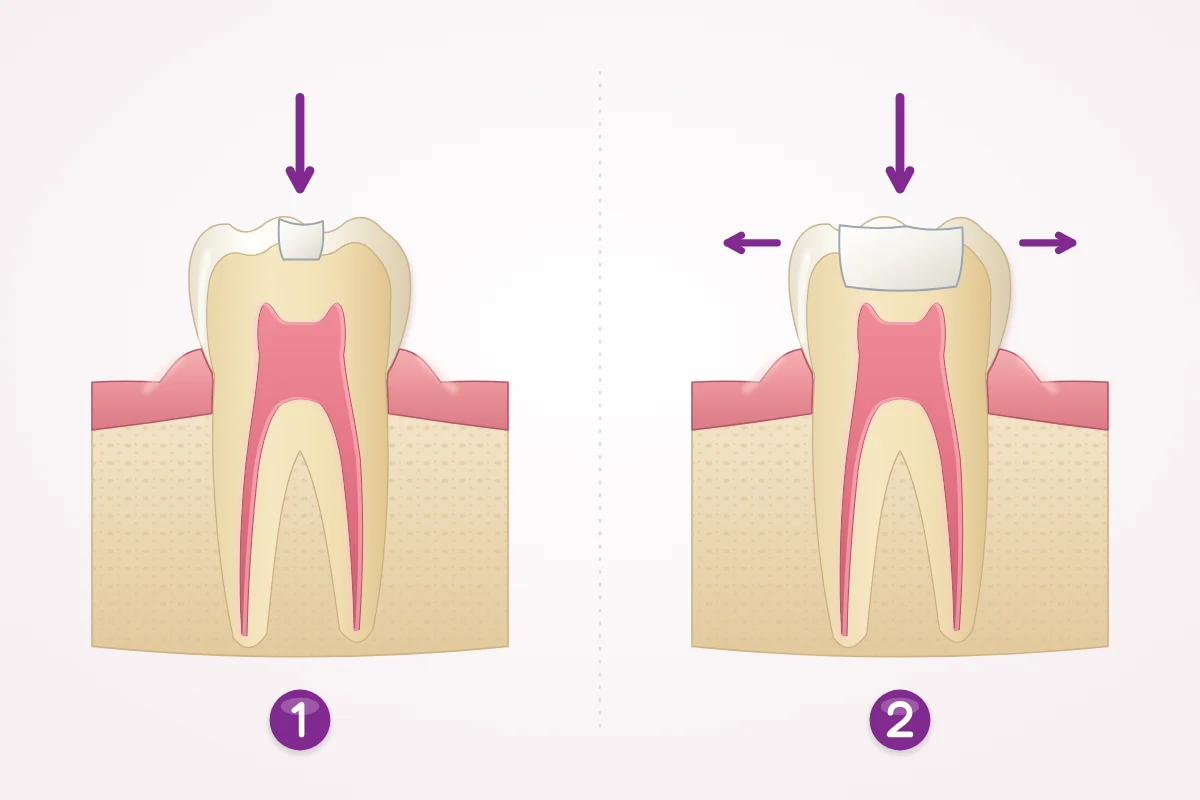 Illustration of two back teeth in cross-section with tooth-colored fillings: a small filling with thick, strong walls, and a wide filling leaving thin walls that can flex outward when biting