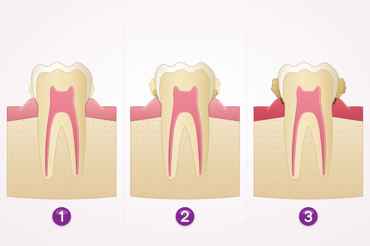 Illustration of a back tooth in cross-section at three moments: a thin soft film of plaque at the gum line, thicker plaque starting to harden at its base, and hard tartar on both sides with a slightly red gum edge