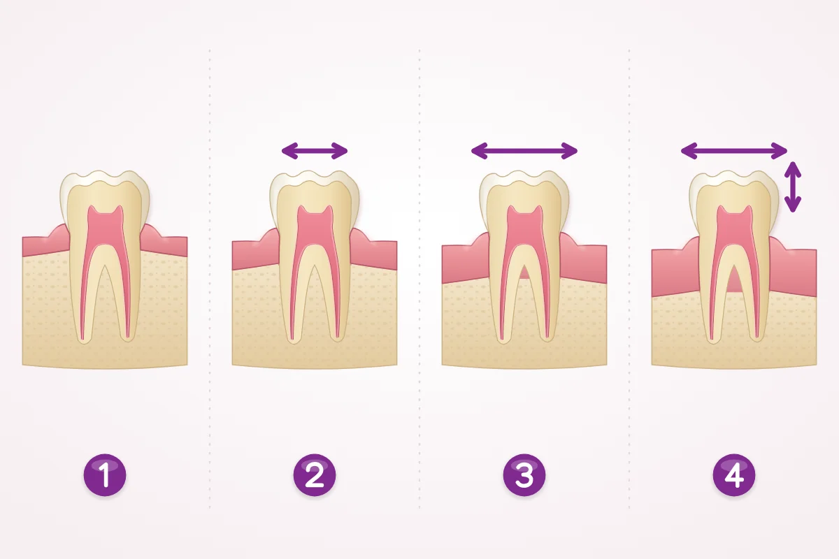 Illustration of four teeth showing mobility from none, to slight and moderate sideways movement, to sideways and up-and-down movement