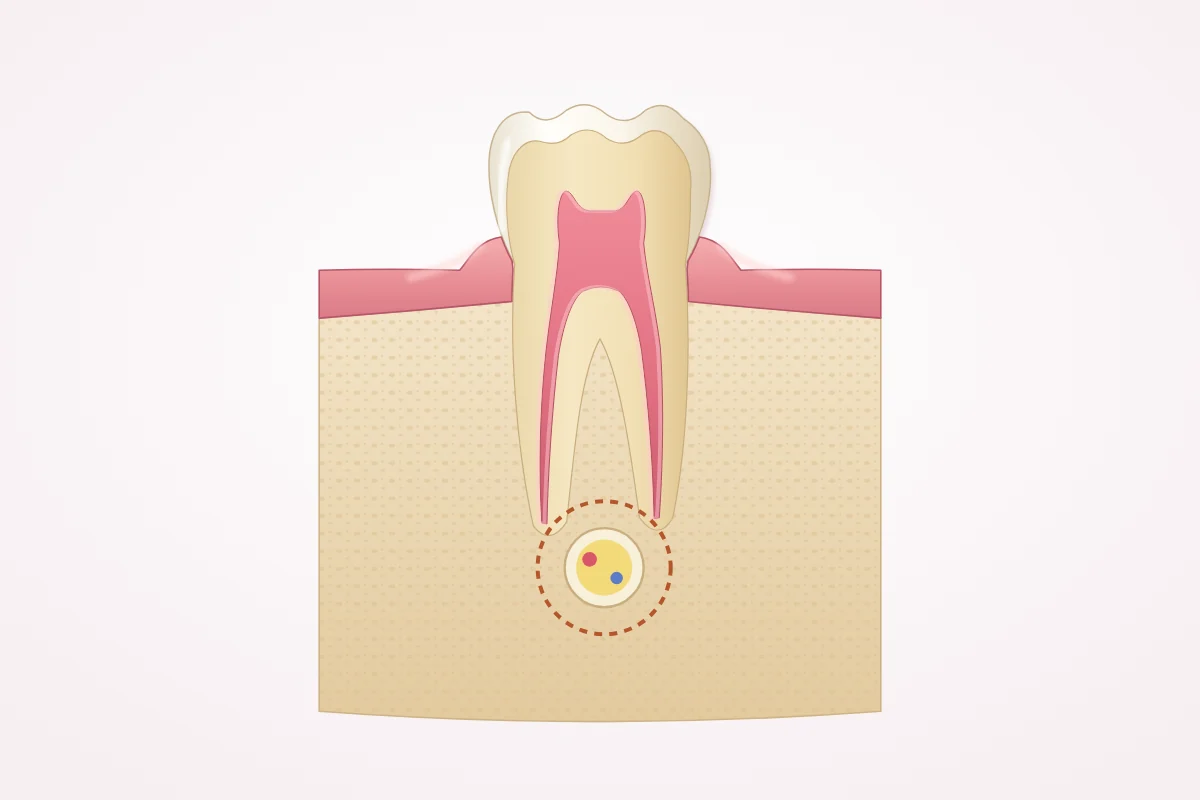 Illustration of the lower jaw in cross-section: a back tooth root lying close to the nerve canal