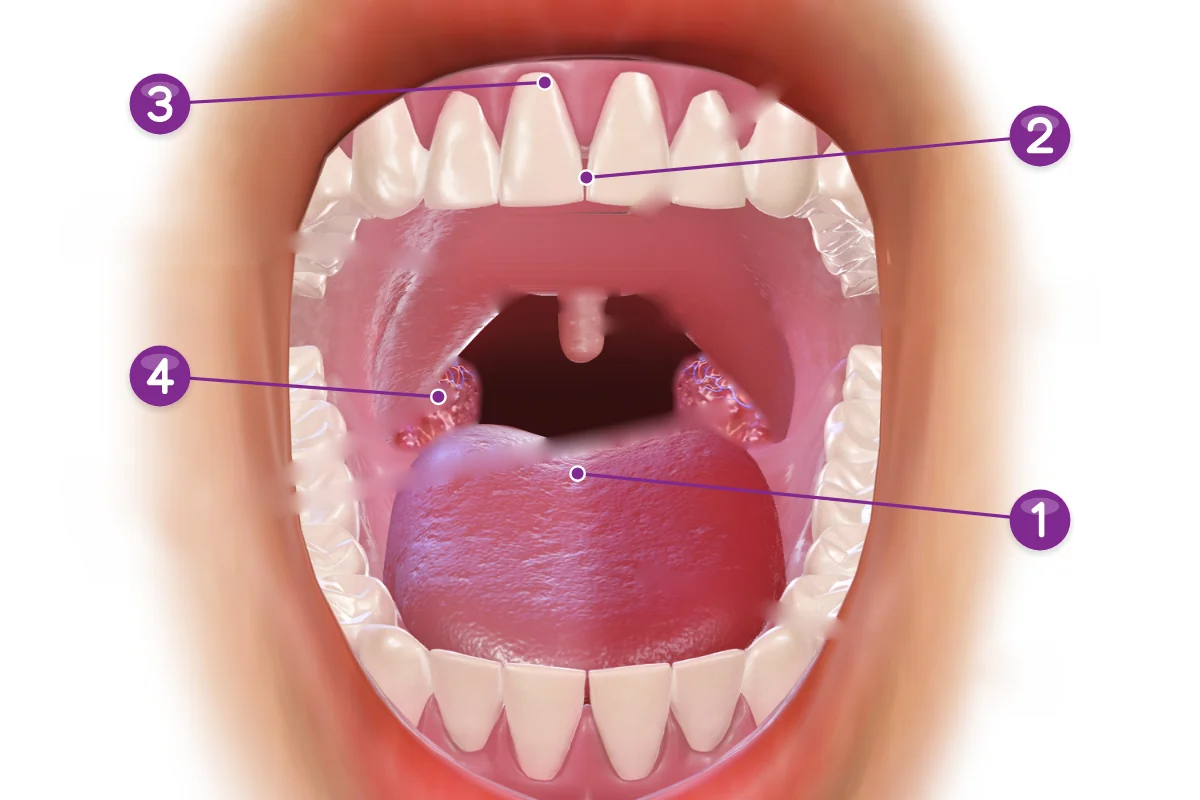 Illustration of an open mouth seen from the front, with numbered points at the back of the tongue, between the upper front teeth, at the gum line and at a tonsil