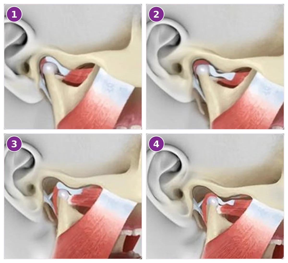 Four close-up illustrations of the jaw joint seen from the side, with the ear on the left: the disc resting on top of the joint head with the mouth closed; the disc slipped forward with the mouth closed; the joint head slid forward with the disc back on top when the mouth opens; and the disc bunched in front of the joint head when the mouth opens
