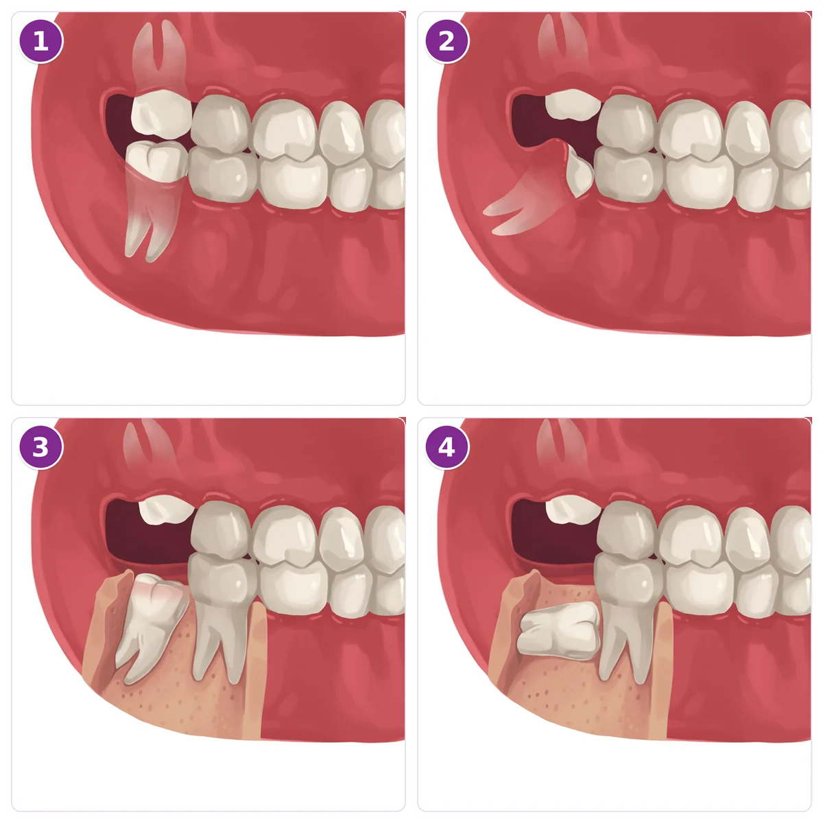 Four illustrations of the back teeth seen from the side, with the gum and jawbone partly see-through or cut away: a lower wisdom tooth fully through the gum; a lower wisdom tooth only partly through, with gum still over part of it; a lower wisdom tooth tilted forward against the molar in front, partly in bone; and a lower wisdom tooth lying flat, fully in bone