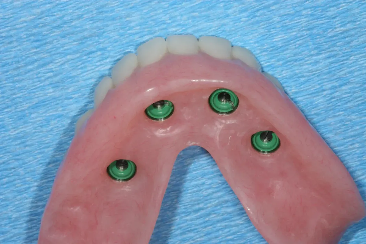 The fitting surface of a complete lower denture with four attachment housings that clip onto dental implants